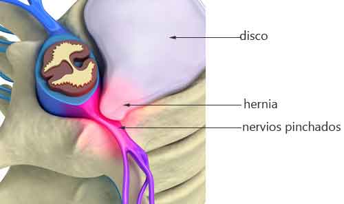 La hernia discal: produce dolor de espalda?