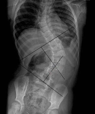 Escoliosis ¿el origen del dolor?