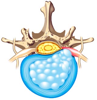 Extrusión | Hernia