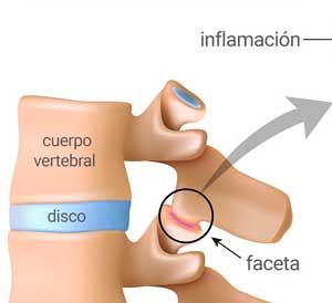 Síndrome Facetario: cómo diagnosticarlo y resolverlo