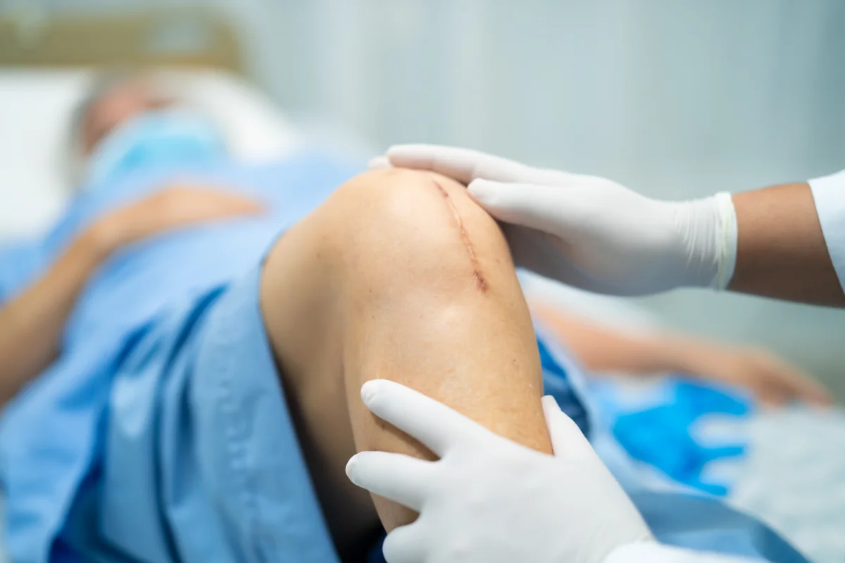 Mis errores tras dos cirugías de rodilla (y cómo evitarlos)